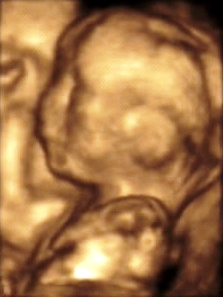 3D ultrasound, taken at 20 weeks